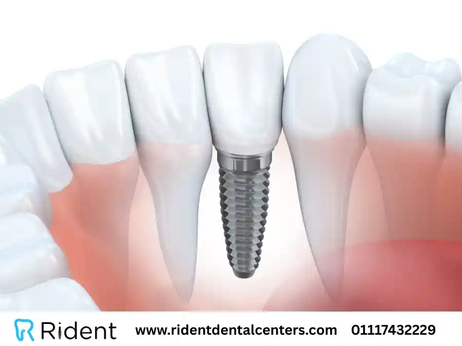 كم مدة زراعة الاسنان؟
